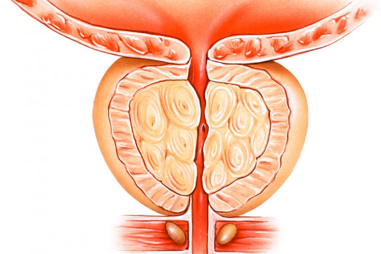 Ilustración hiperplasia benigna de próstata