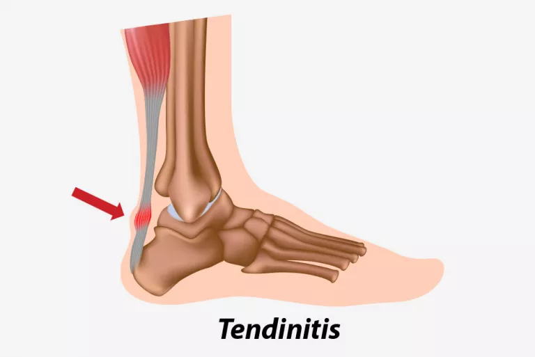 Tendinitis