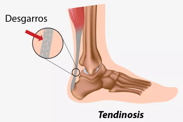 Tendinosis