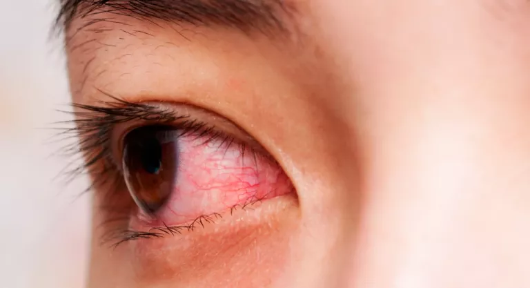 Conjuntivitis por Chagas