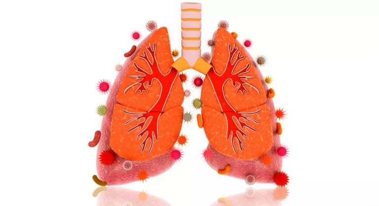 Infección pulmonar por klebsiella