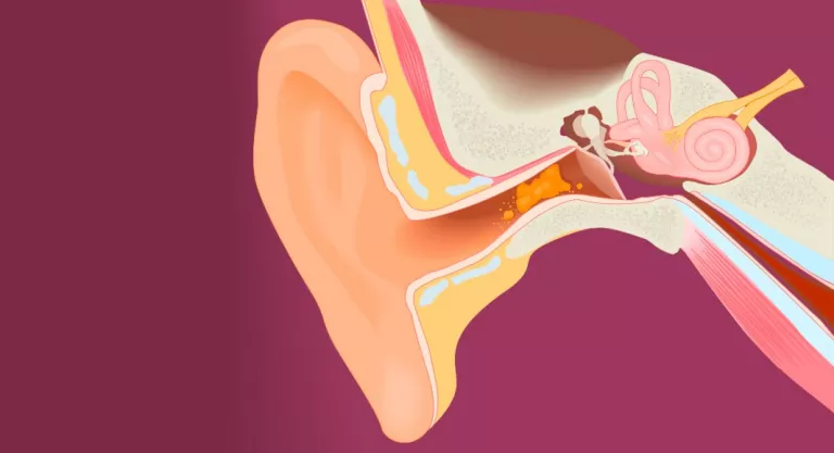 Cómo limpiar los oídos y eliminar tapones de cera sin dañarlos