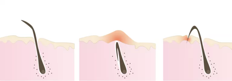 Foliculitis