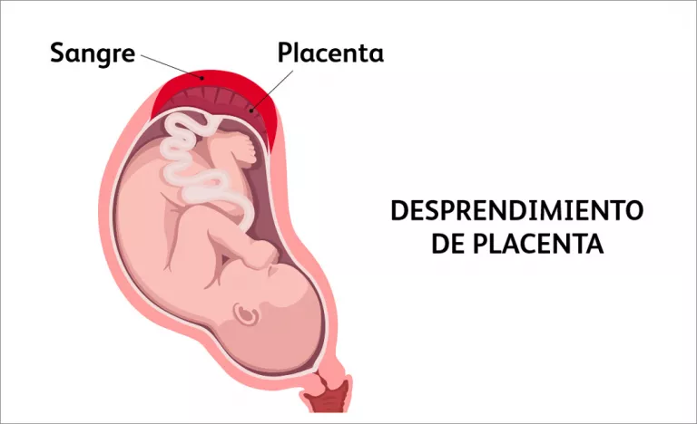 Desprendimiento de placenta