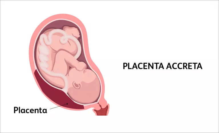 Placenta accreta