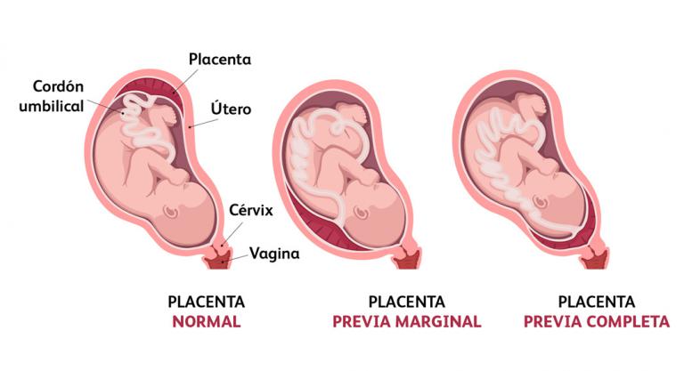 Tipos de placenta