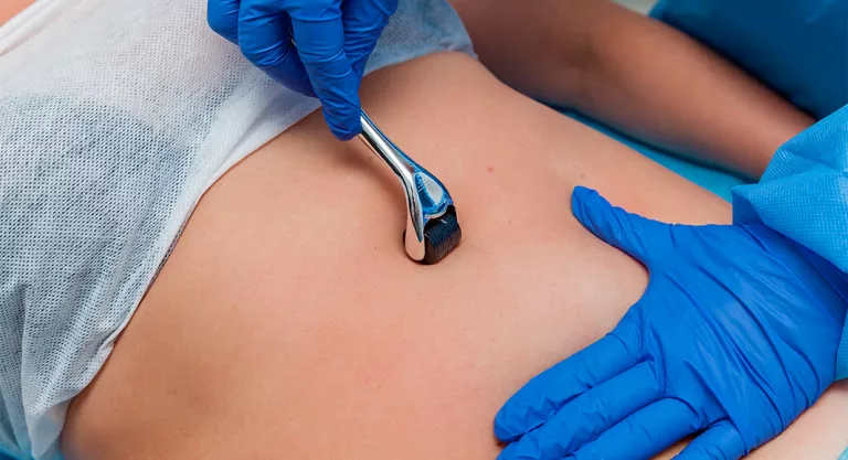 Carboxiterapia