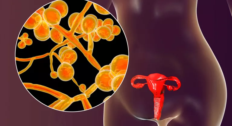 Candidiasis genital