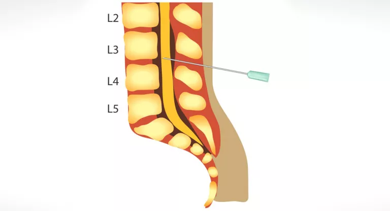 Punción lumbar