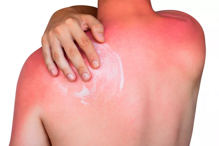 Persona aplicándose aftersun