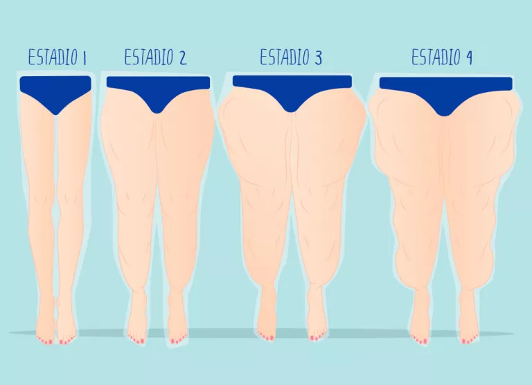 Lipedema, qué es consecuencias de esta de grasa