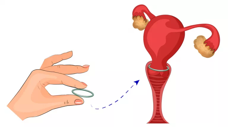 Anillo vaginal