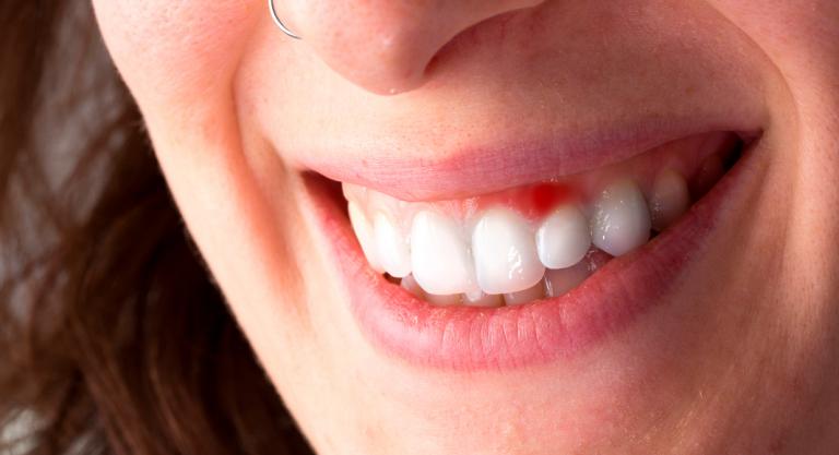 Periodontitis como consecuencia del sarro dental