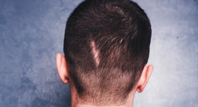 Alopecia cicatrizal