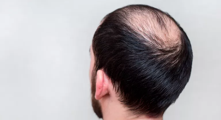 Alopecia común