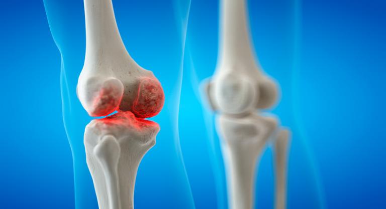 complicații ale inflamației articulare artrite