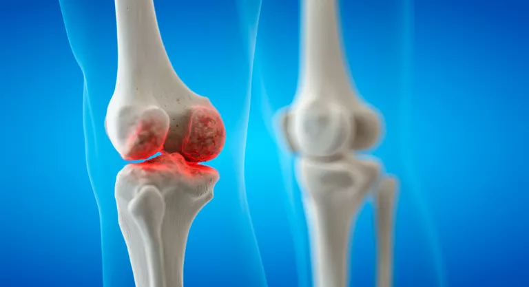 Complicaciones de la artritis reumatoide