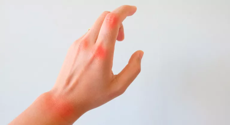 Artritis Artritis reumatoide