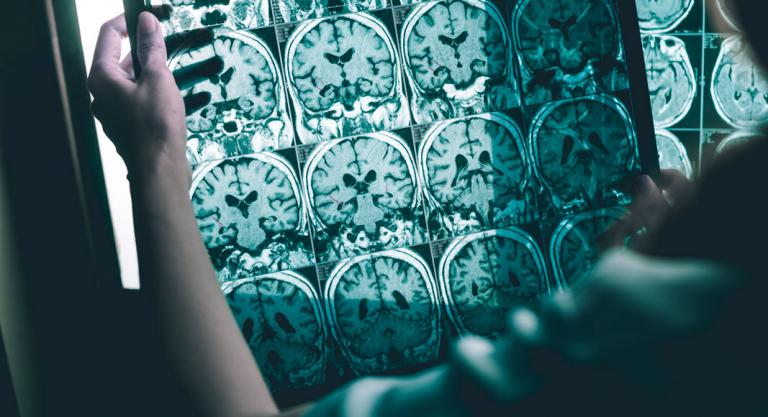 Neurológo analiza la progresión del alzhéimer 