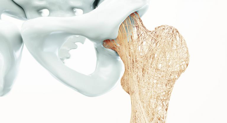 Osteoporosis en la cadera