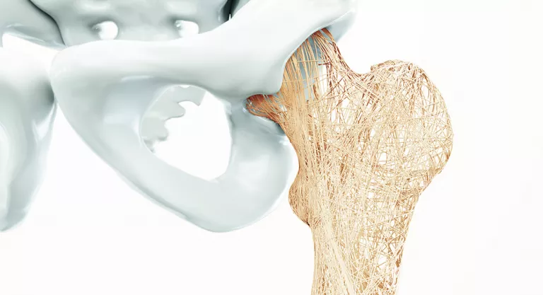 Osteoporosis Osteoporosis en la cadera