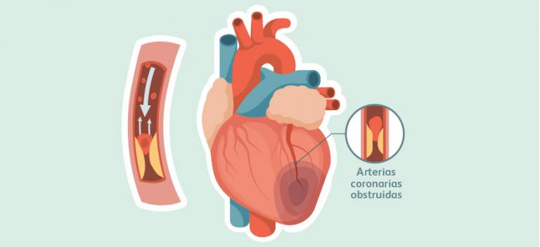 Arterias coronarias obstruidas