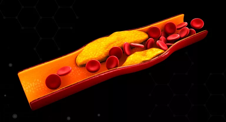 Fett, das die Arterie verstopft