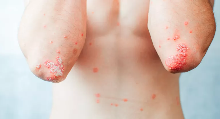 Psoriasis en los codos