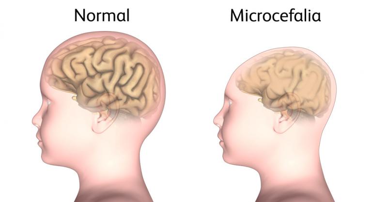 Microcefalia en niños