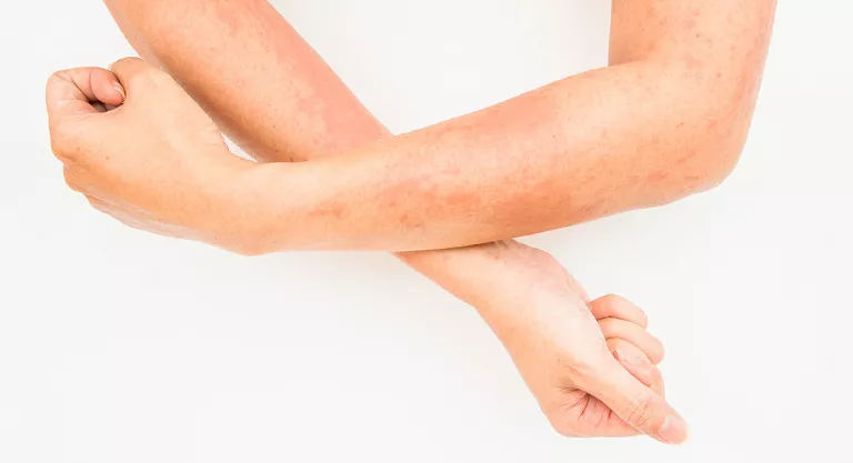 Dermatitis por contacto