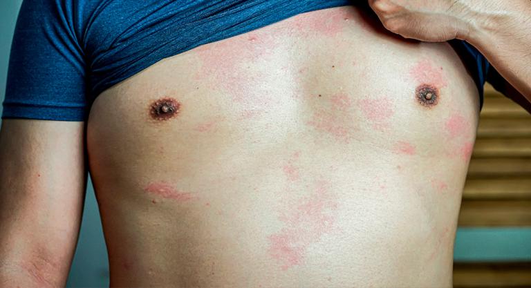 Dermatitis causada por hongos