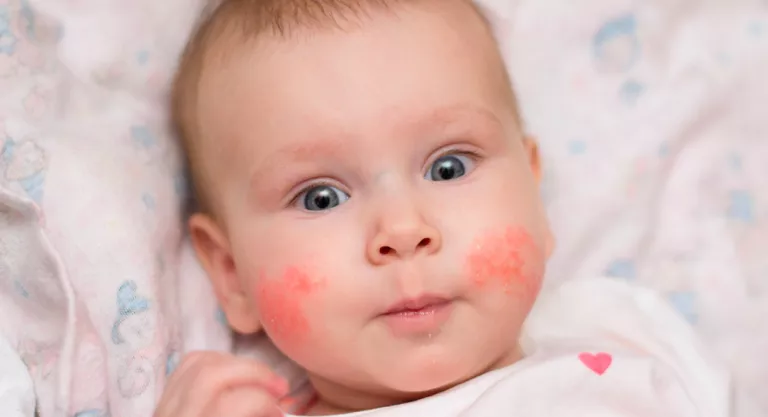 Dermatitis infantil