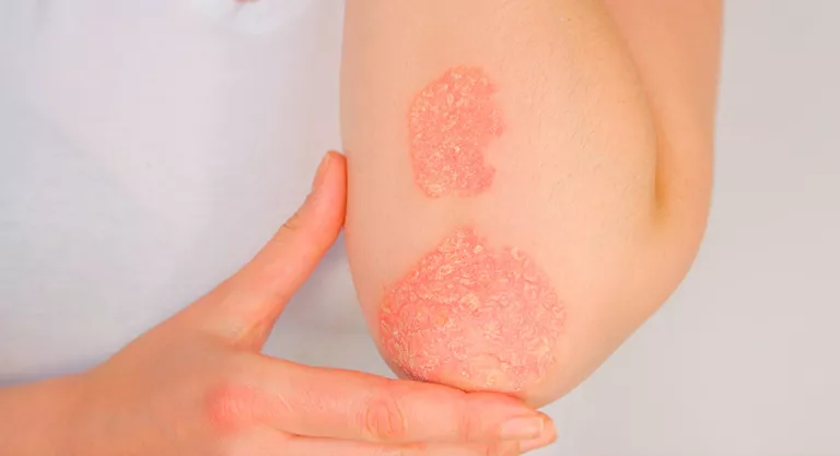 Psoriasis