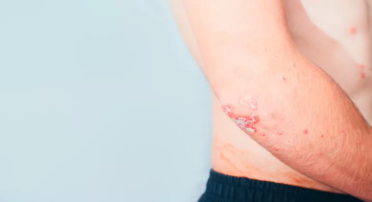 Psoriasis en el codo