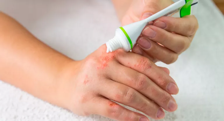 Tratamiento de la dermatitis atópica