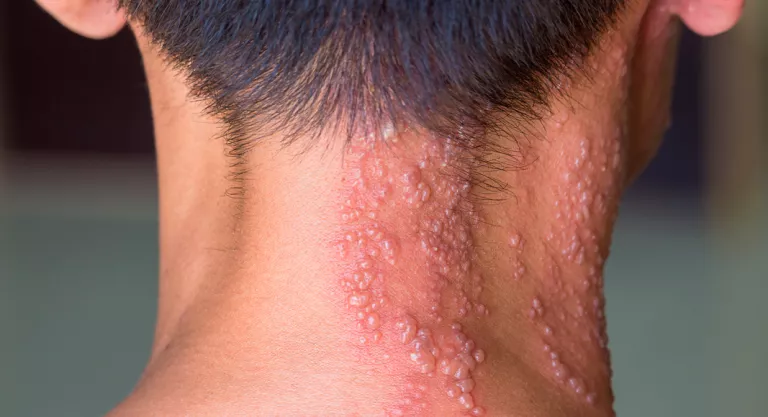 Herpes zóster en el cuello