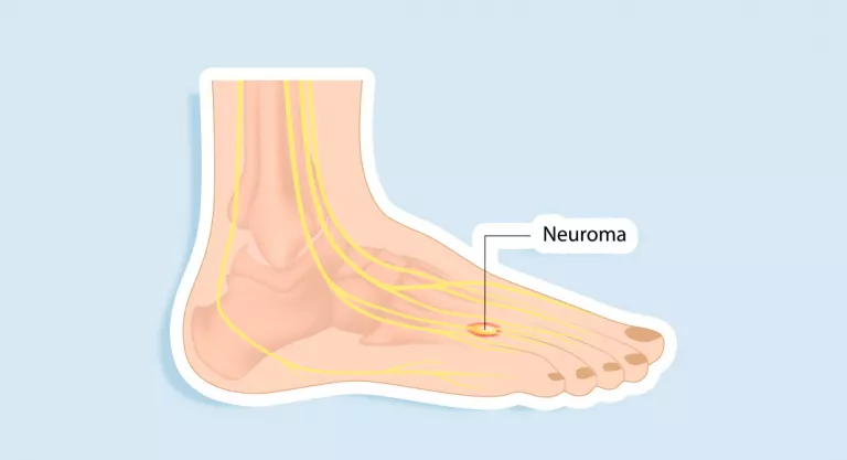 Neuroma de Morton