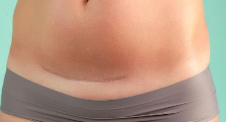Placenta previa: cesárea 