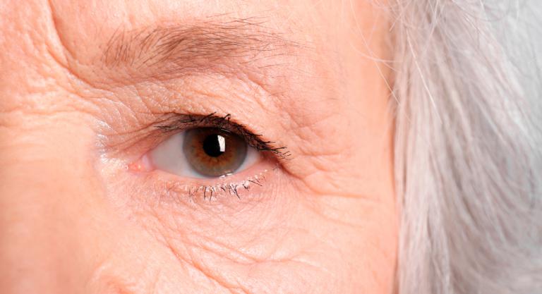 Miopía elevada y glaucoma