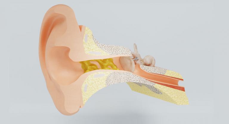 Acumulación de cerumen en el oído puede provocar tinnitus