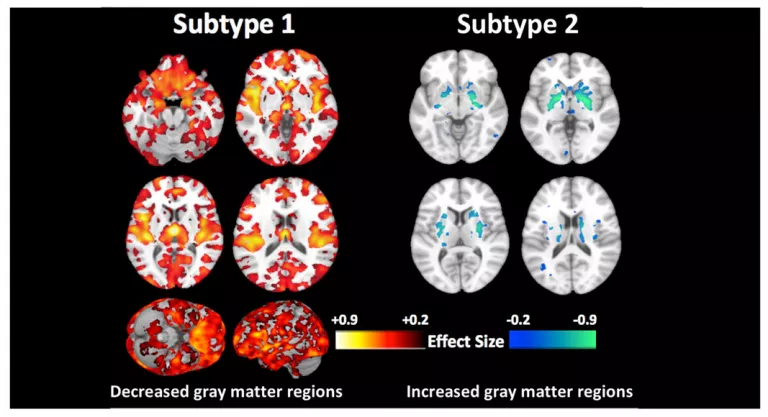 Tipo de esquizofrenia sin anomalías cerebrales