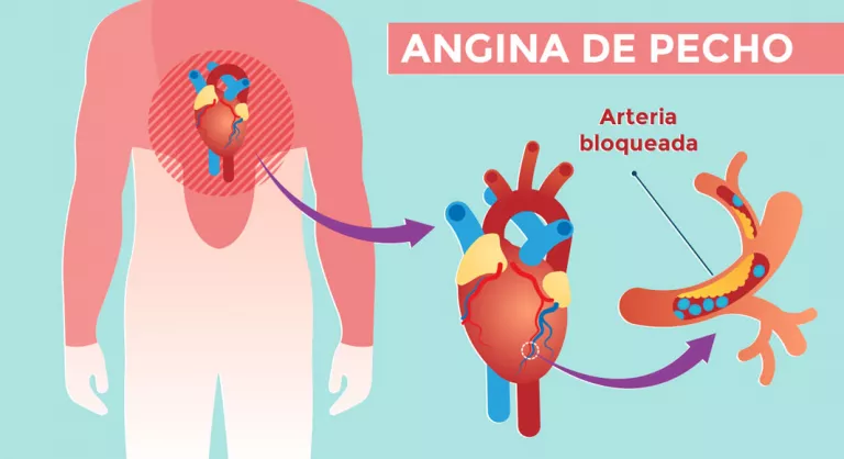 Ilustración de una angina de pecho