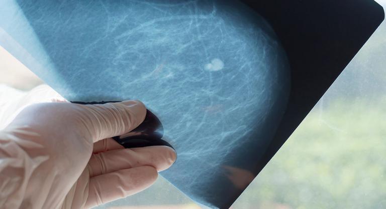 Tumores benignos de la mama: ecografía mamaria