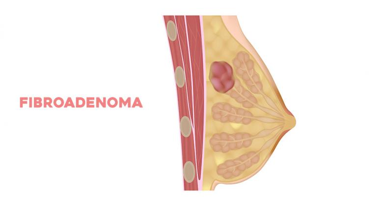 Tumores benignos de la mama: fibroadenoma