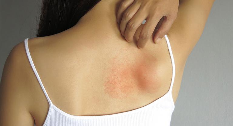 Consejos para evitar que se te pele la piel: no rascar la piel