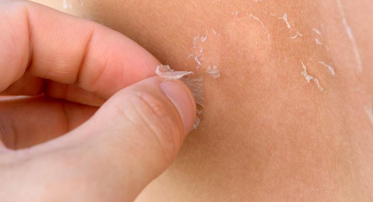 Consejos para evitar que se te pele la piel: no tirar de la piel