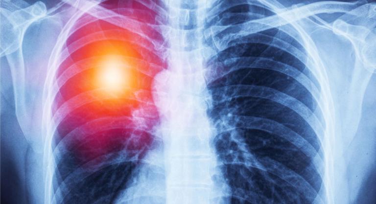 Radiografía de tórax para diagnosticar una angina de pecho