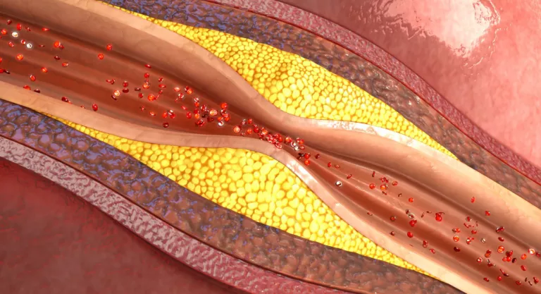 Hipertensión arterial: colesterol