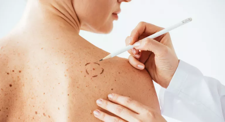 Diagnóstico de un melanoma