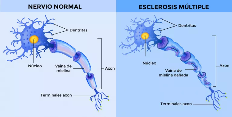 Esclerosis múltiple